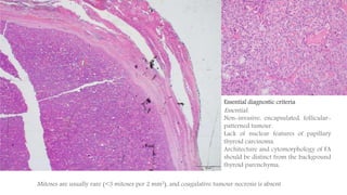 Histology Pictures
Essential diagnostic criteria
Essential:
Non-invasive, encapsulated, follicular-
patterned tumour.
Lack of nuclear features of papillary
thyroid carcinoma.
Architecture and cytomorphology of FA
should be distinct from the background
thyroid parenchyma.
Mitoses are usually rare (<3 mitoses per 2 mm2), and coagulative tumour necrosis is absent
 