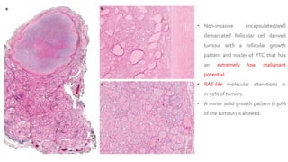 • Non-invasive encapsulated/well
demarcated follicular cell derived
tumour with a follicular growth
pattern and nuclei of PTC that has
an extremely low malignant
potential.
• RAS-like molecular alterations in
in 52% of tumors.
• A minor solid growth pattern (<30%
of the tumour) is allowed.
 