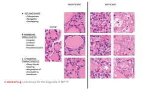A score of 2-3 is necessary for the diagnosis of NIFTP
 