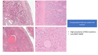 Encapsulated Follicular patterned
tumors
• High prevelance of RAS mutations
• Lack BRAF V600E
 