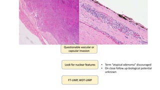 Questionable vascular or
capsular invasion
Look for nuclear features
FT-UMP, WDT-UMP
• Term “atypical adenoma” discouraged
• On close follow up-biological potential
unknown
 