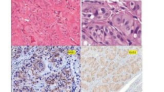 MIB1 GLIS1
 