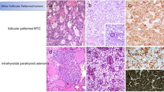 Other Follicular Patterned tumors
follicular patterned MTC
intrathyroidal parathyroid adenoma
 
