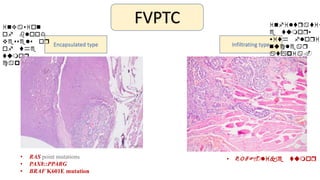 FVPTC
Encapsulated type Infiltrating type
invasion
of blood
vessels or
of the
tumor
capsule.
infiltrativ
e tumors
with florid
nuclear
atypia.
• RAS point mutations
• PAX8::PPARG
• BRAF K601E mutation
• BRAF-like tumor
 