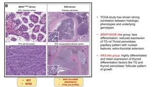 • TCGA study has shown strong
correlation between histologic
phenotypes and underlying
genotypes
• BRAFV600E-like group: less
differentiation, reduced expression
of TG nd Throid peroxidase,
papillary pattern with nuclear
features; extra-thyroidal extension
• RAS-like group :highly differentiated
and retain expression of thyroid
differentiation factors like TG and
thyroid peroxidase: follicular pattern
of growth
• RET
• NTRK
• BRAF-Nonv600E
(BRAFK601E)
• PTEN, Pax-8-PPAR
 