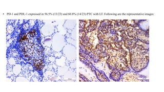 • PD-1 and PDL-1 expressed in 56.5% (13/23) and 60.8% (14/23) PTC with LT. Following are the representative images:
 
