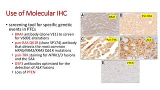 Use of Molecular IHC
• screening tool for specific genetic
events in PTCs
• BRAF antibody (clone VE1) to screen
for V600E alterations
• pan-RAS Q61R (clone SP174) antibody
that detects the most common
HRAS/NRAS/KRAS Q61R mutations
• pan-TRK staining for NTRK1/3 fusions
and the 5A4
• D5F3 antibodies optimized for the
detection of ALK fusions
• Loss of PTEN
BRAF
Pan-TRK
Pan RAS
ALK
PTEN
 