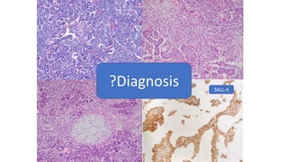 SALL-4
?Diagnosis
 