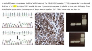 A total of 26 cases were analysed for BRAF v600Emutation. The BRAFv600E mutation (T1799 A transversion) was observed
in 11 out of 26 (42.3%) cases of PTC with LT. The base Thymine was transversed to Adenine in these cases. Following figure
describes the representative chromatograms of Sanger sequencing where the T1799 A transversion was observed.
 
