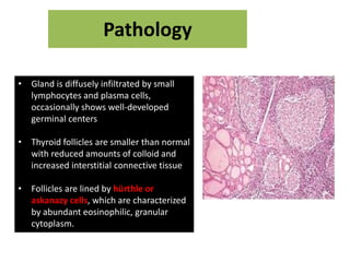 Pathology
• Gland is diffusely infiltrated by small
lymphocytes and plasma cells,
occasionally shows well-developed
germinal centers
• Thyroid follicles are smaller than normal
with reduced amounts of colloid and
increased interstitial connective tissue
• Follicles are lined by hürthle or
askanazy cells, which are characterized
by abundant eosinophilic, granular
cytoplasm.
 