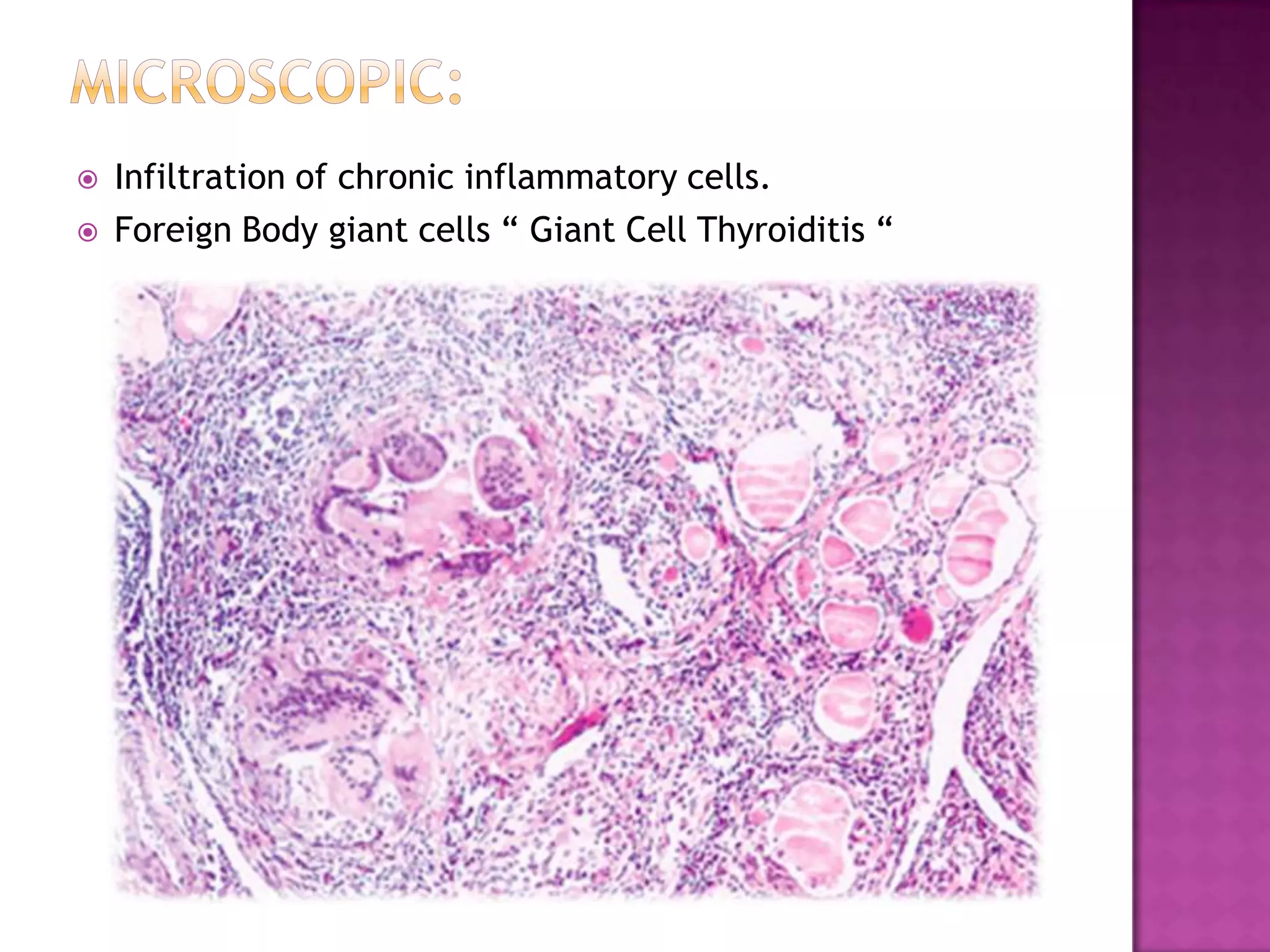 


Infiltration of chronic inflammatory cells.
Foreign Body giant cells “ Giant Cell Thyroiditis “

 