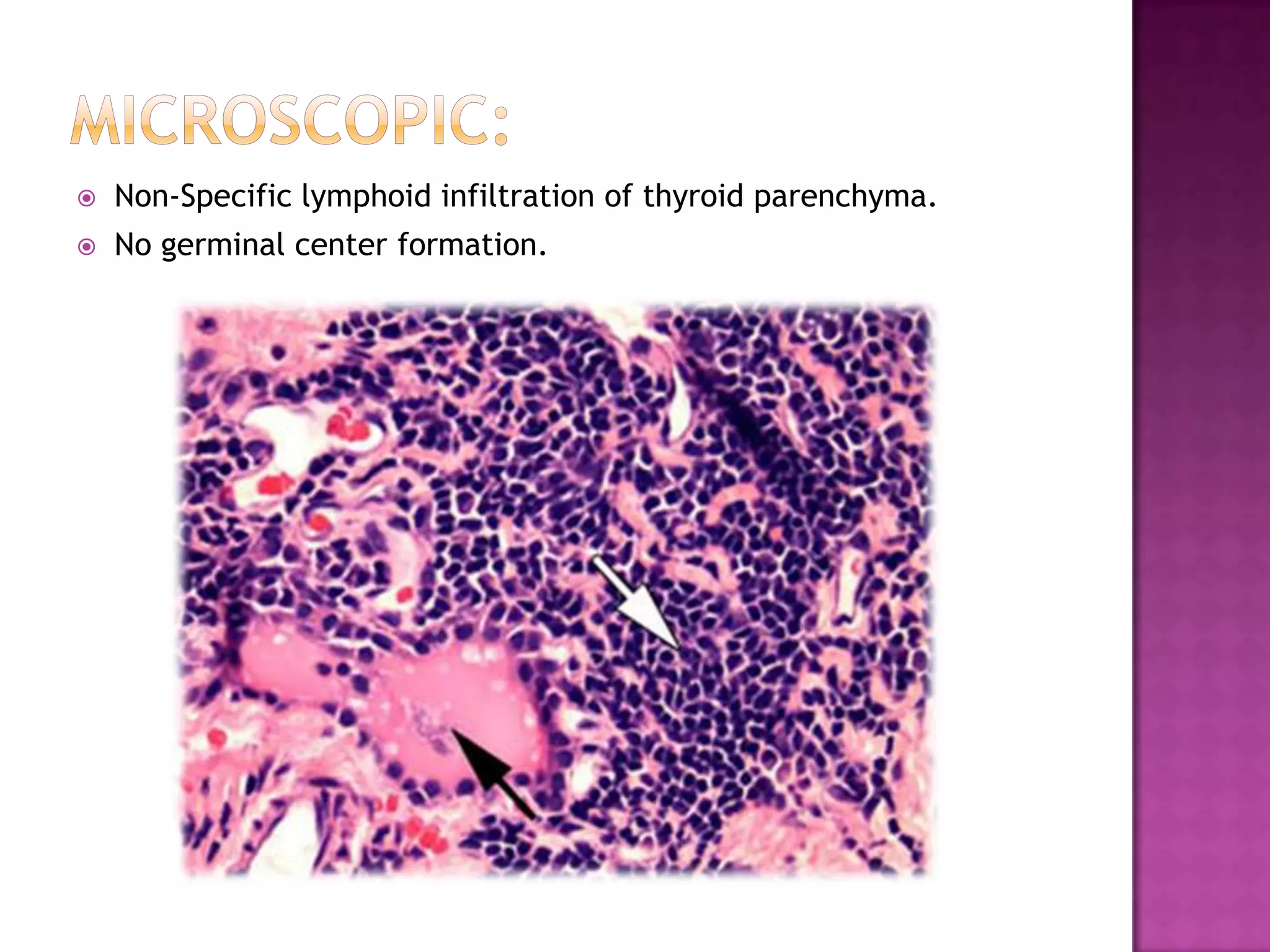 

Non-Specific lymphoid infiltration of thyroid parenchyma.



No germinal center formation.

 
