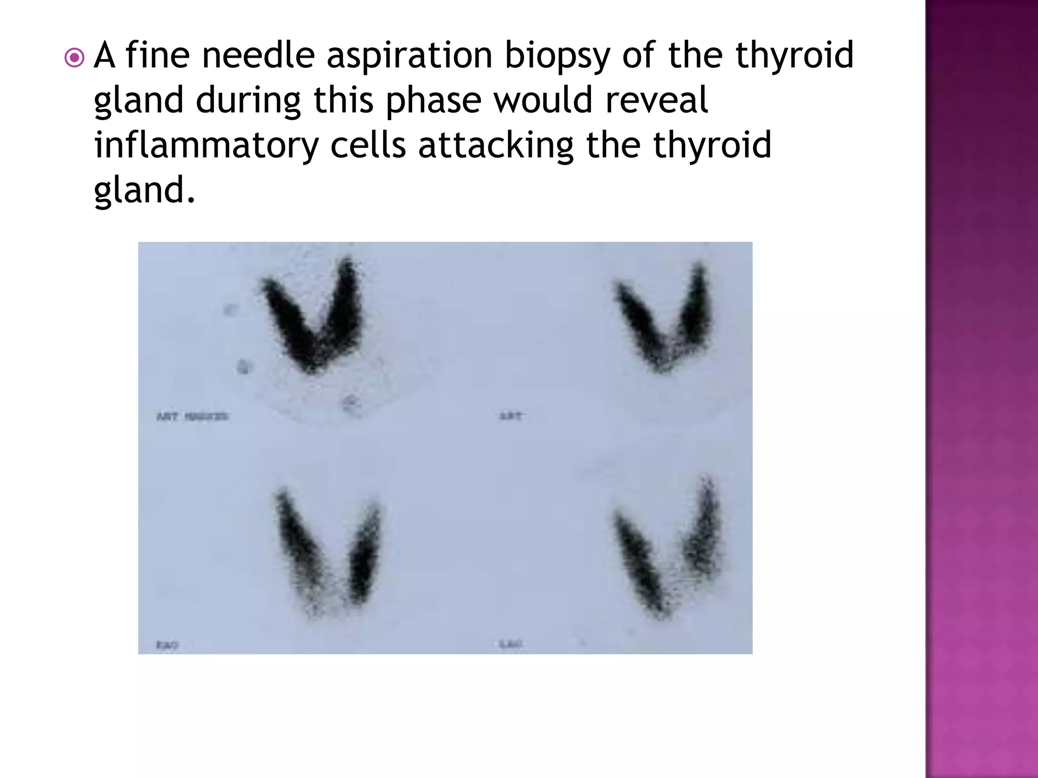 A

fine needle aspiration biopsy of the thyroid
gland during this phase would reveal
inflammatory cells attacking the thyroid
gland.

 