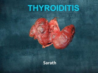 THYROIDITIS
Sarath
 
