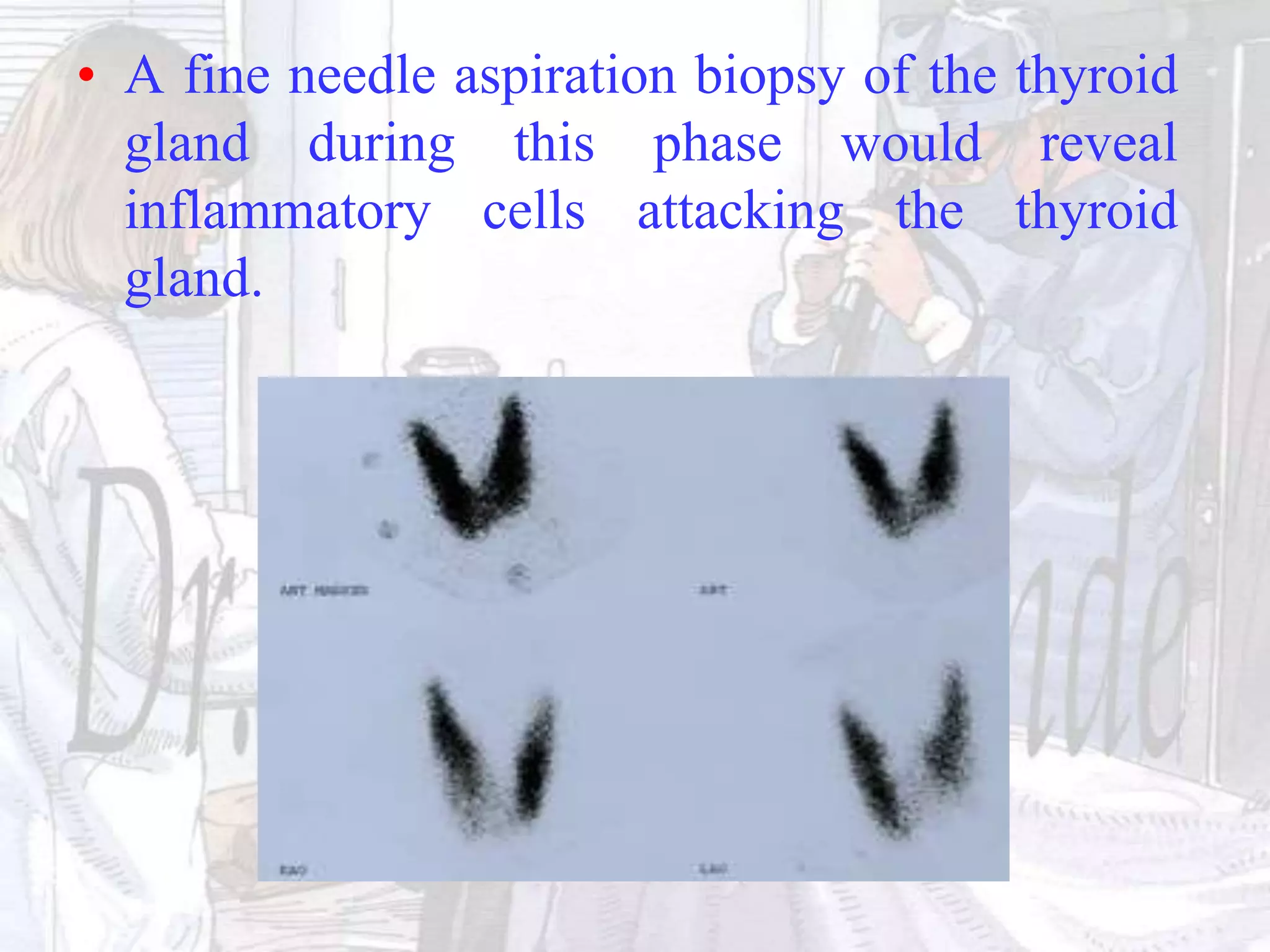 • A fine needle aspiration biopsy of the thyroid
gland during this phase would reveal
inflammatory cells attacking the thyroid
gland.
 
