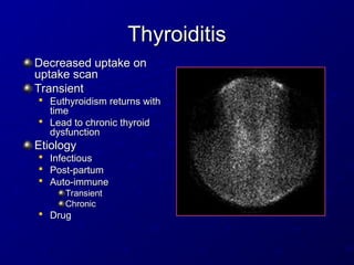 Thyroiditis
Thyroiditis
Decreased uptake on
Decreased uptake on
uptake scan
uptake scan
Transient
Transient

Euthyroidism returns with
Euthyroidism returns with
time
time

Lead to chronic thyroid
Lead to chronic thyroid
dysfunction
dysfunction
Etiology
Etiology

Infectious
Infectious

Post-partum
Post-partum

Auto-immune
Auto-immune
Transient
Transient
Chronic
Chronic

Drug
Drug
 