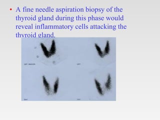 • A fine needle aspiration biopsy of the
thyroid gland during this phase would
reveal inflammatory cells attacking the
thyroid gland.
 