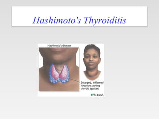 Hashimoto's Thyroiditis
 