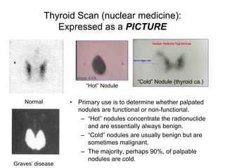 Thyroid Scan (nuclear medicine):
Expressed as a PICTURE
• Primary use is to determine whether palpated
nodules are functional or non-functional.
– “Hot” nodules concentrate the radionuclide
and are essentially always benign.
– “Cold” nodules are usually benign but are
sometimes malignant.
– The majority, perhaps 90%, of palpable
nodules are cold.
Normal
“Hot” Nodule
“Cold” Nodule (thyroid ca.)
Graves’ disease
 