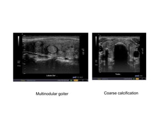 Multinodular goiter Coarse calcification
 