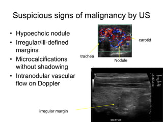 Suspicious signs of malignancy by US
• Hypoechoic nodule
• Irregular/ill-defined
margins
• Microcalcifications
without shadowing
• Intranodular vascular
flow on Doppler
carotid
trachea
Nodule
irregular margin
 