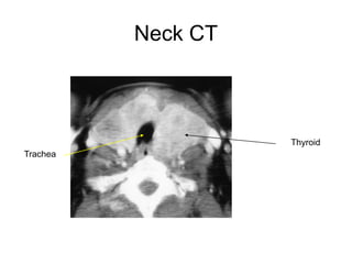 Neck CT
Thyroid
Trachea
 