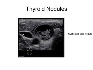 Thyroid Nodules
Cystic and solid nodule
 