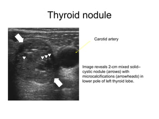 Thyroid nodule
Image reveals 2-cm mixed solid–
cystic nodule (arrows) with
microcalcifications (arrowheads) in
lower pole of left thyroid lobe.
Carotid artery
 