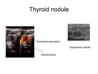Thyroid nodule
Increased vascularity
Carotid artery
Hypoechoic nodule
 