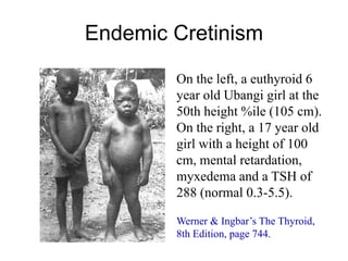Endemic Cretinism
On the left, a euthyroid 6
year old Ubangi girl at the
50th height %ile (105 cm).
On the right, a 17 year old
girl with a height of 100
cm, mental retardation,
myxedema and a TSH of
288 (normal 0.3-5.5).
Werner & Ingbar’s The Thyroid,
8th Edition, page 744.
 