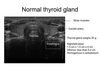 Normal thyroid gland
Thyroid gland weighs 20 g.
Right/left lobes:
1.5 cm x 1.5 cm x 4 cm.
Isthmus: less than 0.4 cm
Homogenous in echotexture.
Carotid artery
Trachea
Esophagus
Strap muscles
 