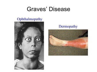 Graves’ Disease
Dermopathy
Ophthalmopathy
 