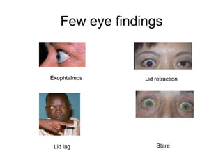 Few eye findings
Stare
Lid retraction
Lid lag
Exophtalmos
 