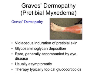 Graves’ Dermopathy
(Pretibial Myxedema)
• Violaceous induration of pretibial skin
• Glycosaminoglycan deposition
• Rare, generally accompanied by eye
disease
• Usually asymptomatic
• Therapy typically topical glucocorticoids
Graves’ Dermopathy
 