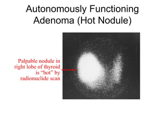 Autonomously Functioning
Adenoma (Hot Nodule)
Palpable nodule in
right lobe of thyroid
is “hot” by
radionuclide scan
 