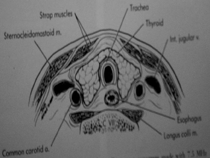DR RAJ BUMIYA'S THYROID LESIONS USG - ULTRASONOGRAPHY