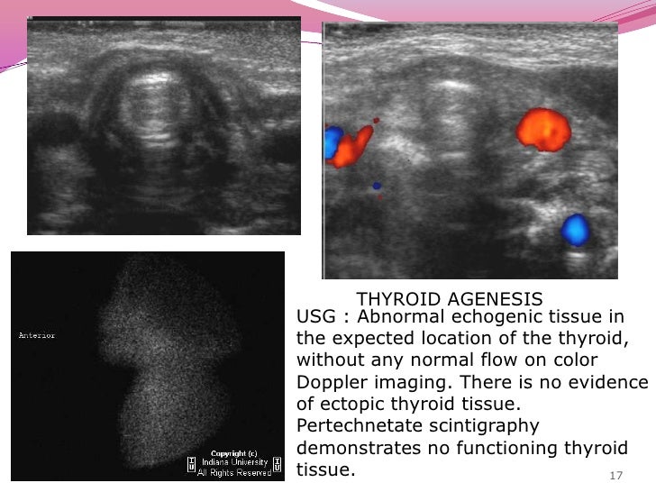 DR RAJ BUMIYA'S THYROID LESIONS USG ULTRASONOGRAPHY
