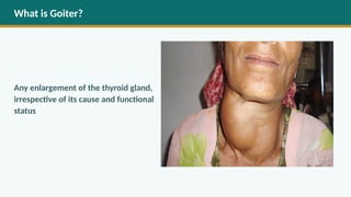 Goiter Approach Comprehensive Overview of Thyroid Gland, Goiter, and Surgical ...