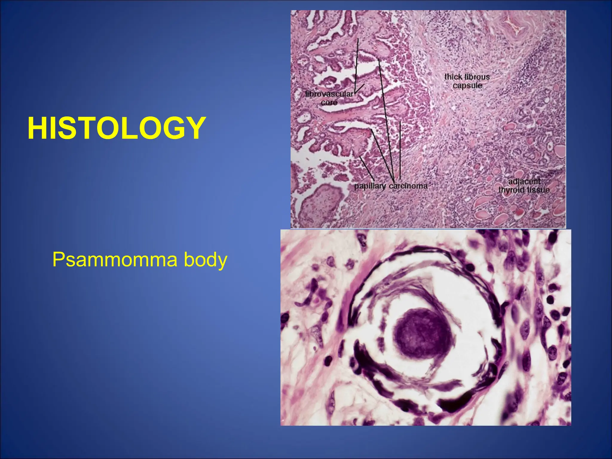 HISTOLOGY
Psammomma body
 