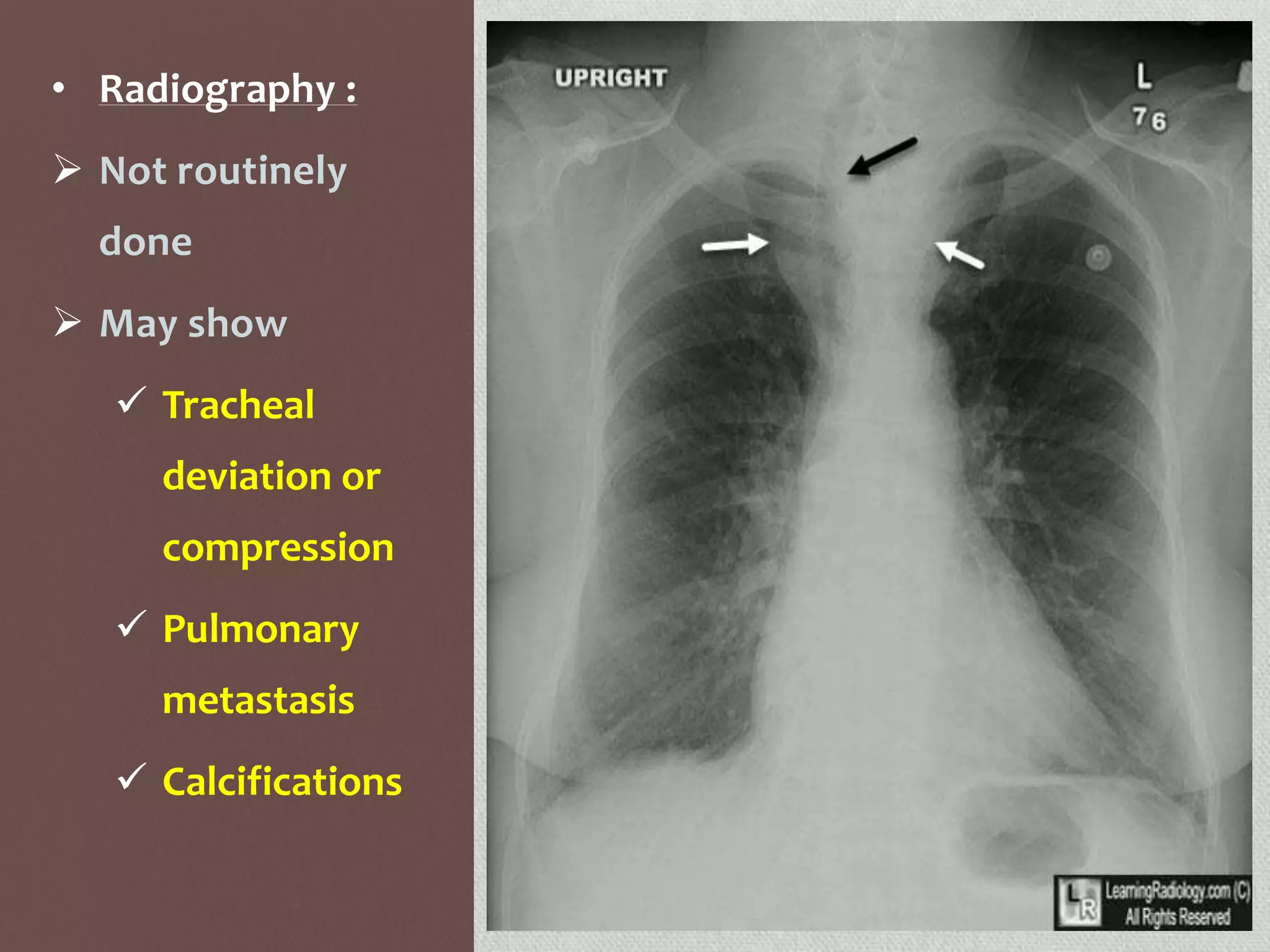 • Radiography :
 Not routinely
done
 May show
 Tracheal
deviation or
compression
 Pulmonary
metastasis
 Calcifications
 