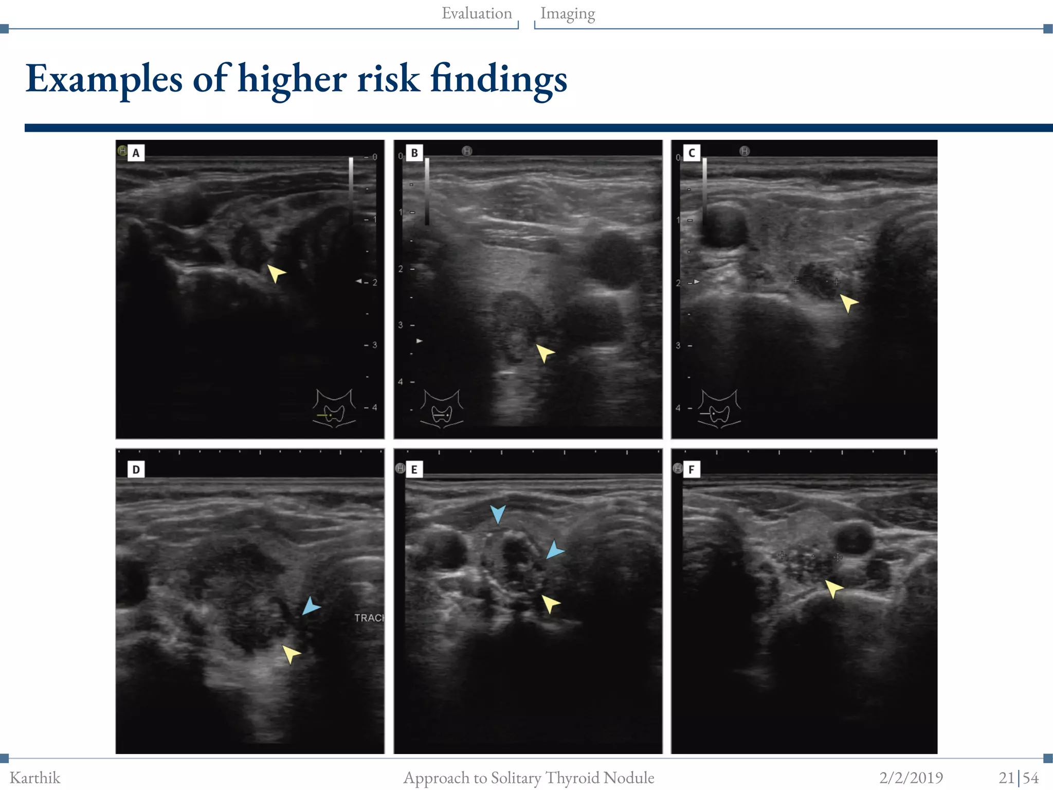 Approach to Solitary Thyroid nodule | PDF