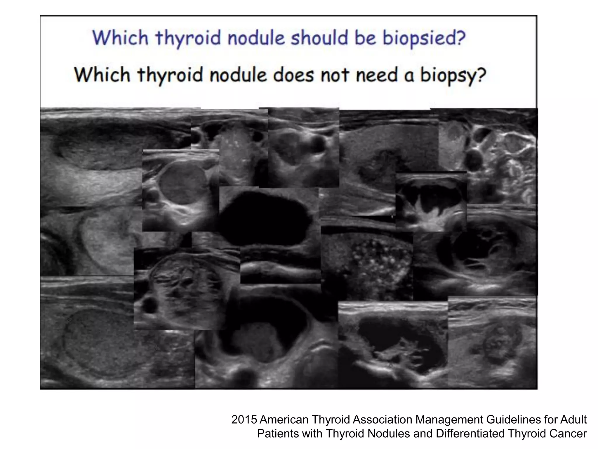 Thyroid nodules and cancer | PDF
