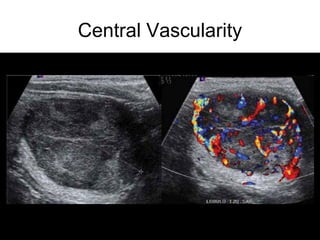 Central Vascularity
 