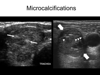 Microcalcifications
 