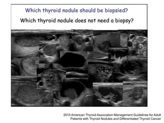 2015 American Thyroid Association Management Guidelines for Adult
Patients with Thyroid Nodules and Differentiated Thyroid Cancer
 