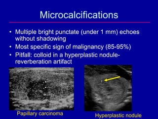 The Epidemic of Thyroid Nodules: Which Should Undergo Fine Needle ...