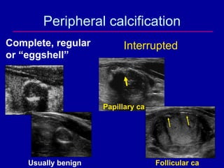 Peripheral calcification
Complete, regular         Interrupted
or “eggshell”




                     Papillary ca




   ...