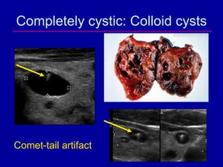 Completely cystic: Colloid cysts




Comet-tail artifact
 