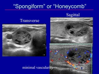 “Spongiform” or “Honeycomb”
                         Sagittal
  Transverse




   minimal vascularity
 