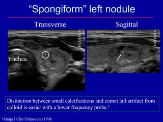 “Spongiform” left nodule
                    Transverse                      Sagittal



   trachea




  Distinction betw...